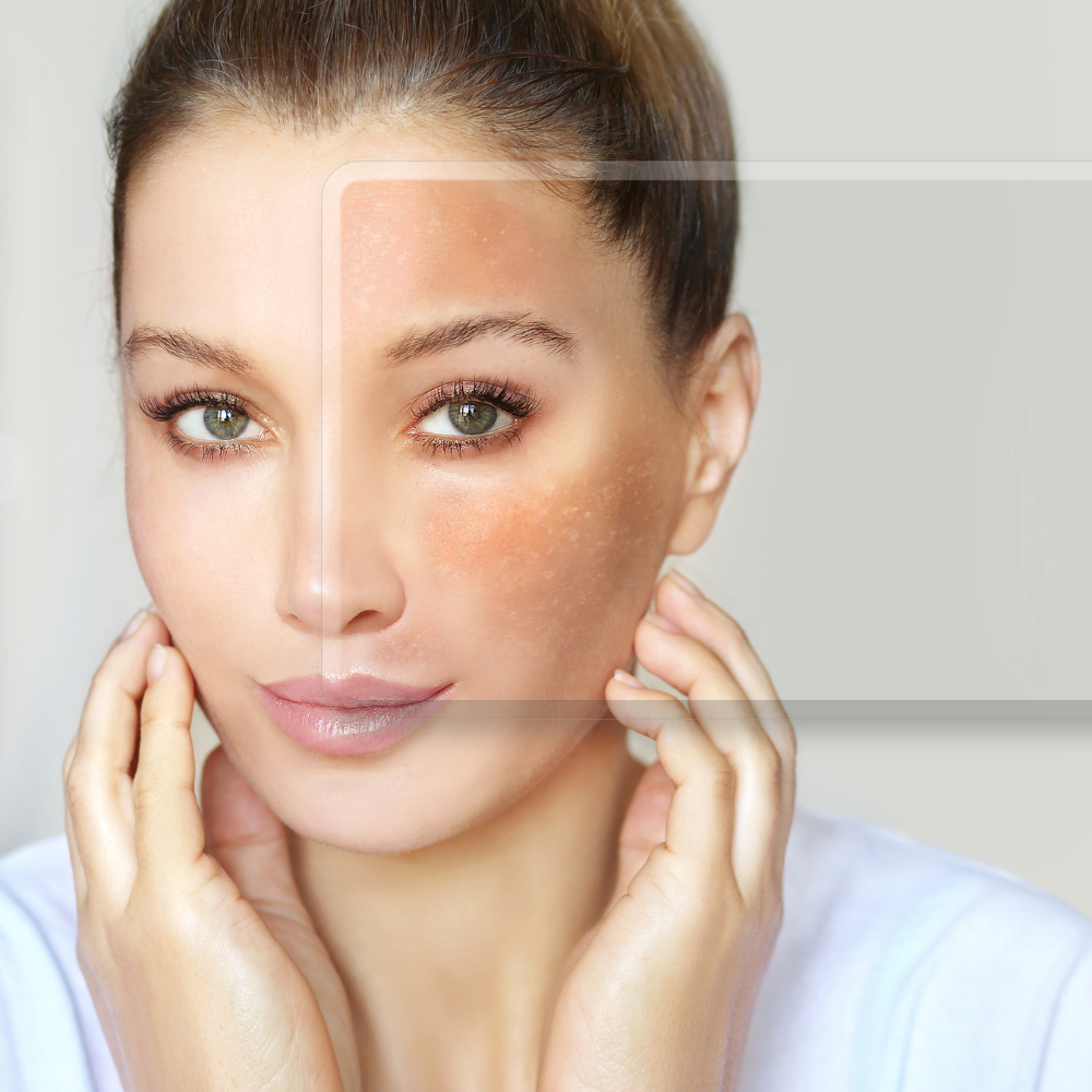 Melasma